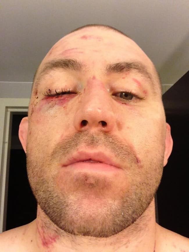 AlanBelcher_eye_UFC159 (1)
